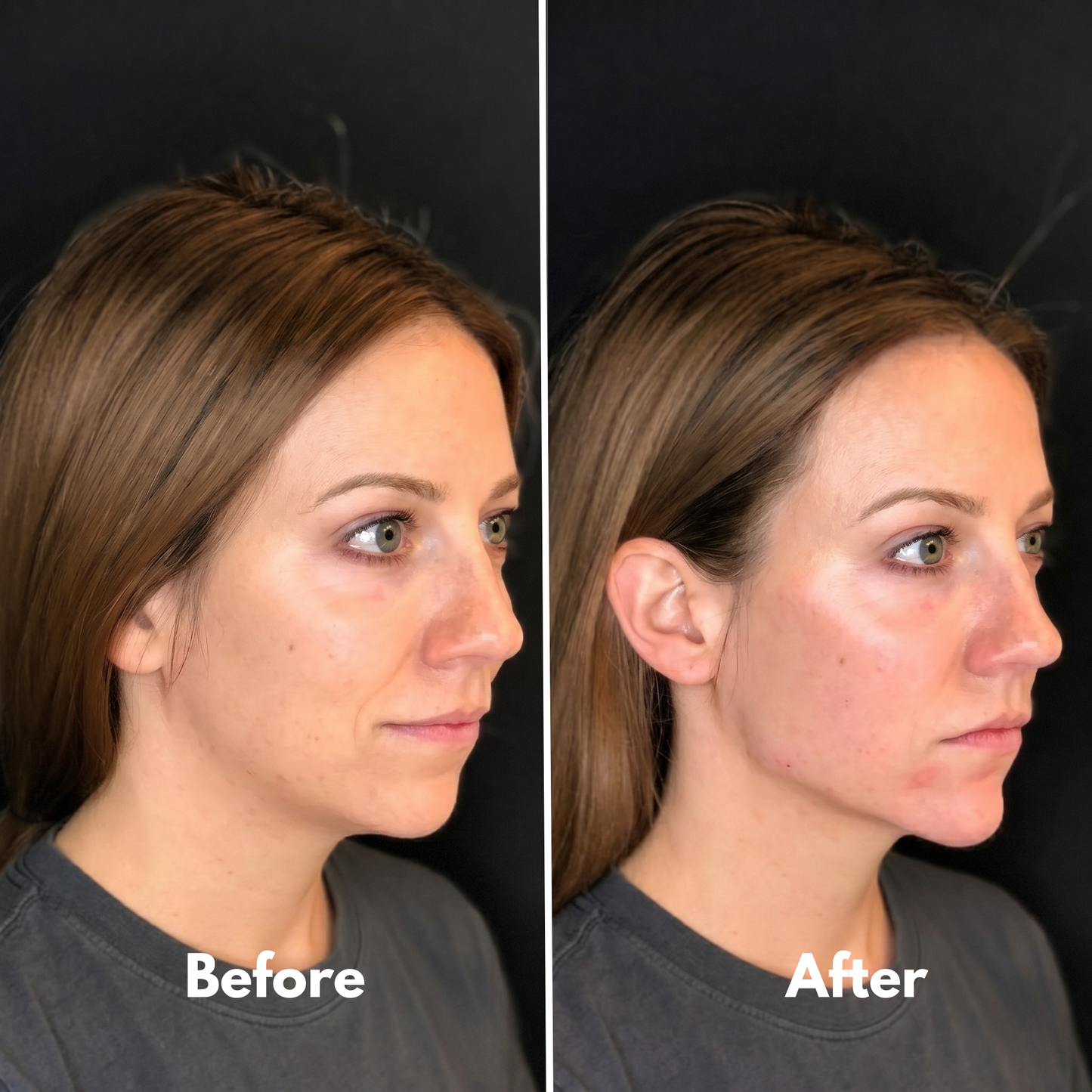 V-Lift Define™ Mask by Liftae